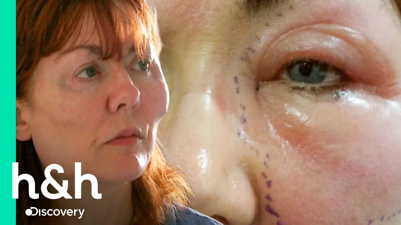Una mujer devastada y deforme al ser inyectada con relleno | Cirujanos al Rescate | Discovery H&H