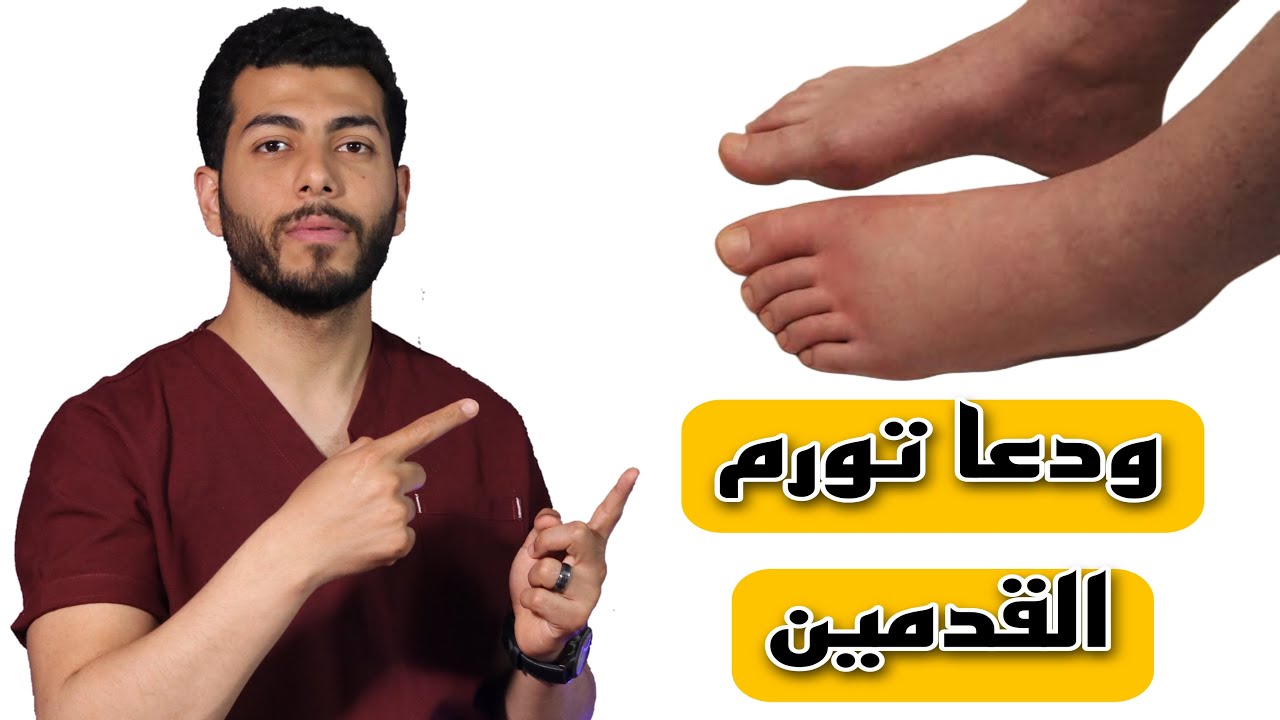 اسرع علاج لتورم القدمين فى المنزل وبدون أدوية|تورم القدمين الاسباب والعلاج |انتفاخ القدمين