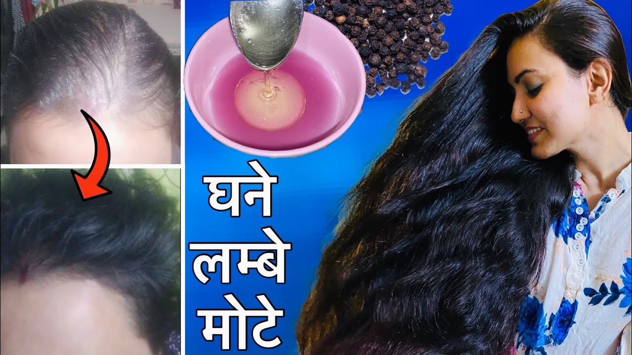 30 Days Challenge : गंजेपन, Receding Hairline, Bald Patches हल्के बालों को करें मोटा और घना ❤️