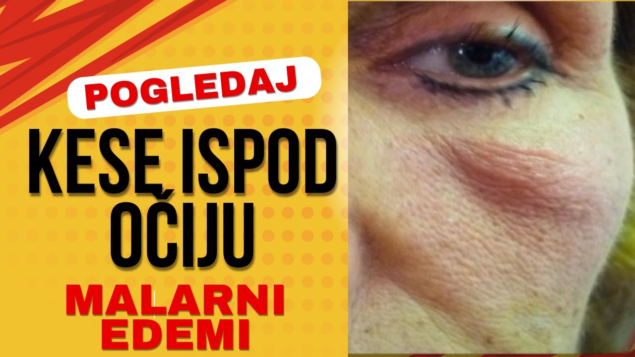 Kese ispod očiju: Malarni Edemi: Razlozi Nastanka i Metodi Lečenja