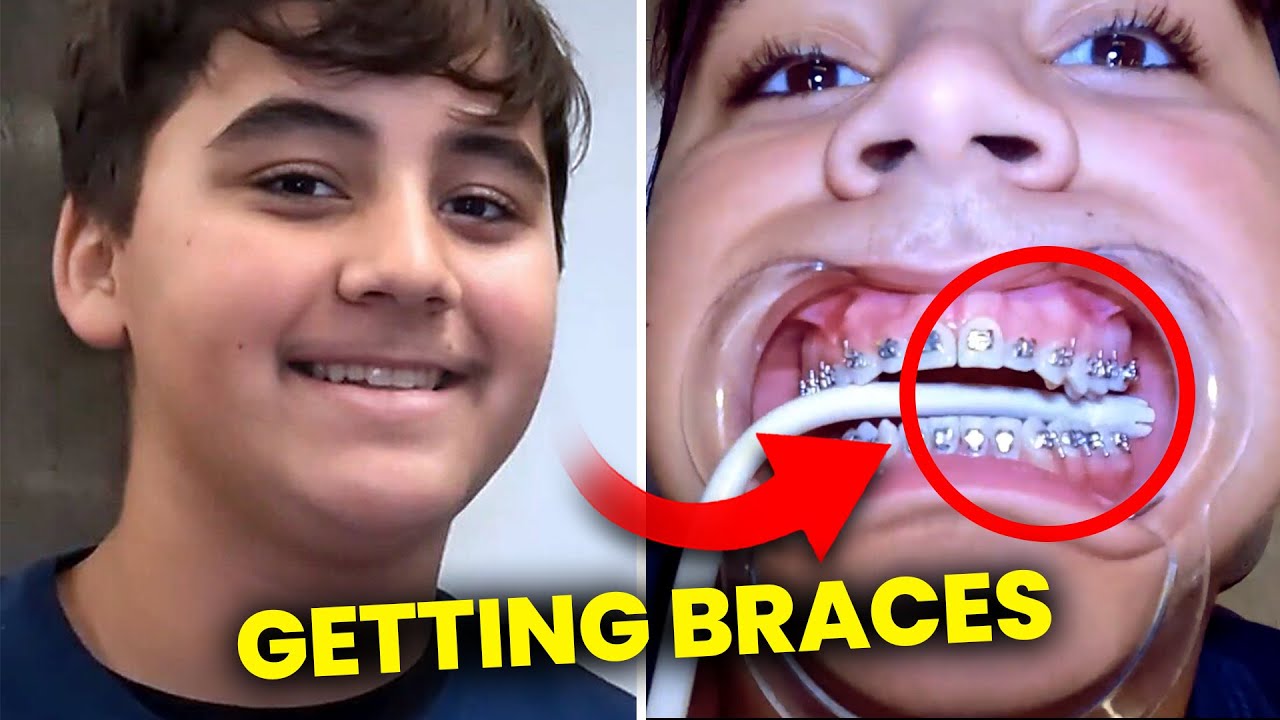 Patient getting BRACES on…full process | McKinney Orthodontist