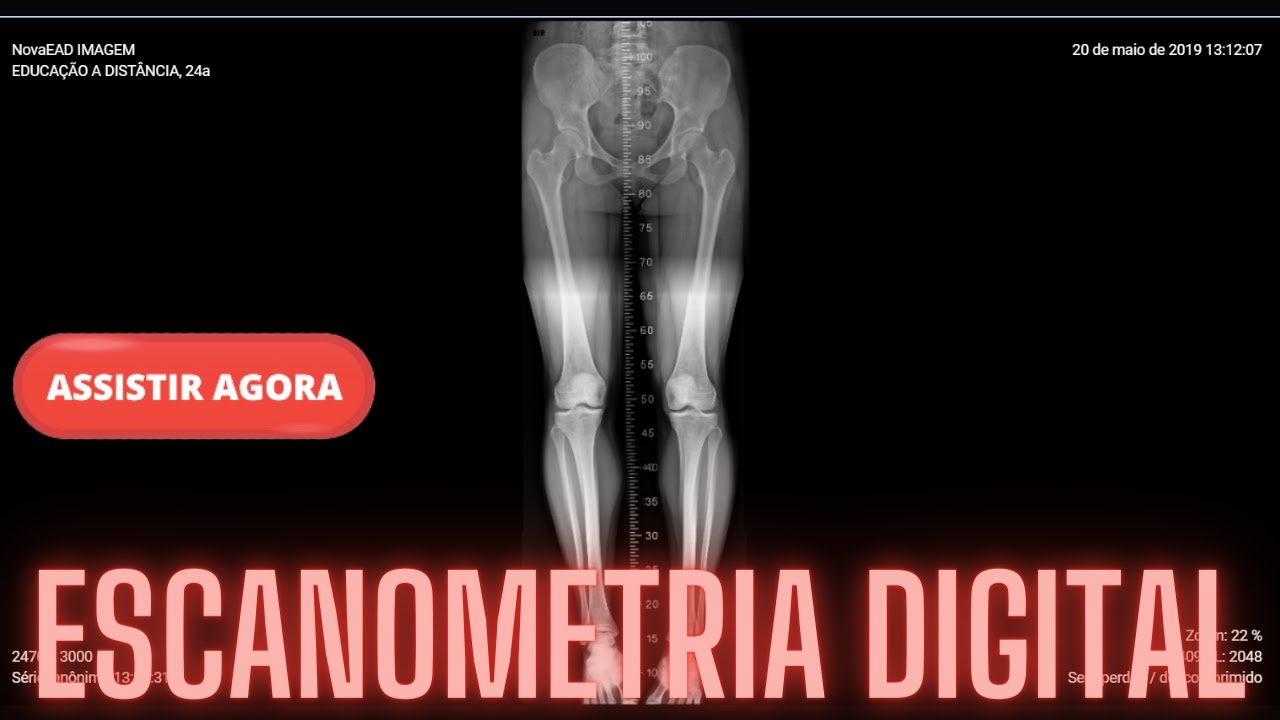 ESCANOMETRIA DIGITAL
