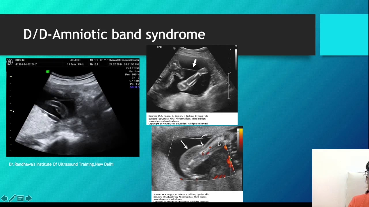 Amniotic sheet,band,circumvallate placenta,septum?