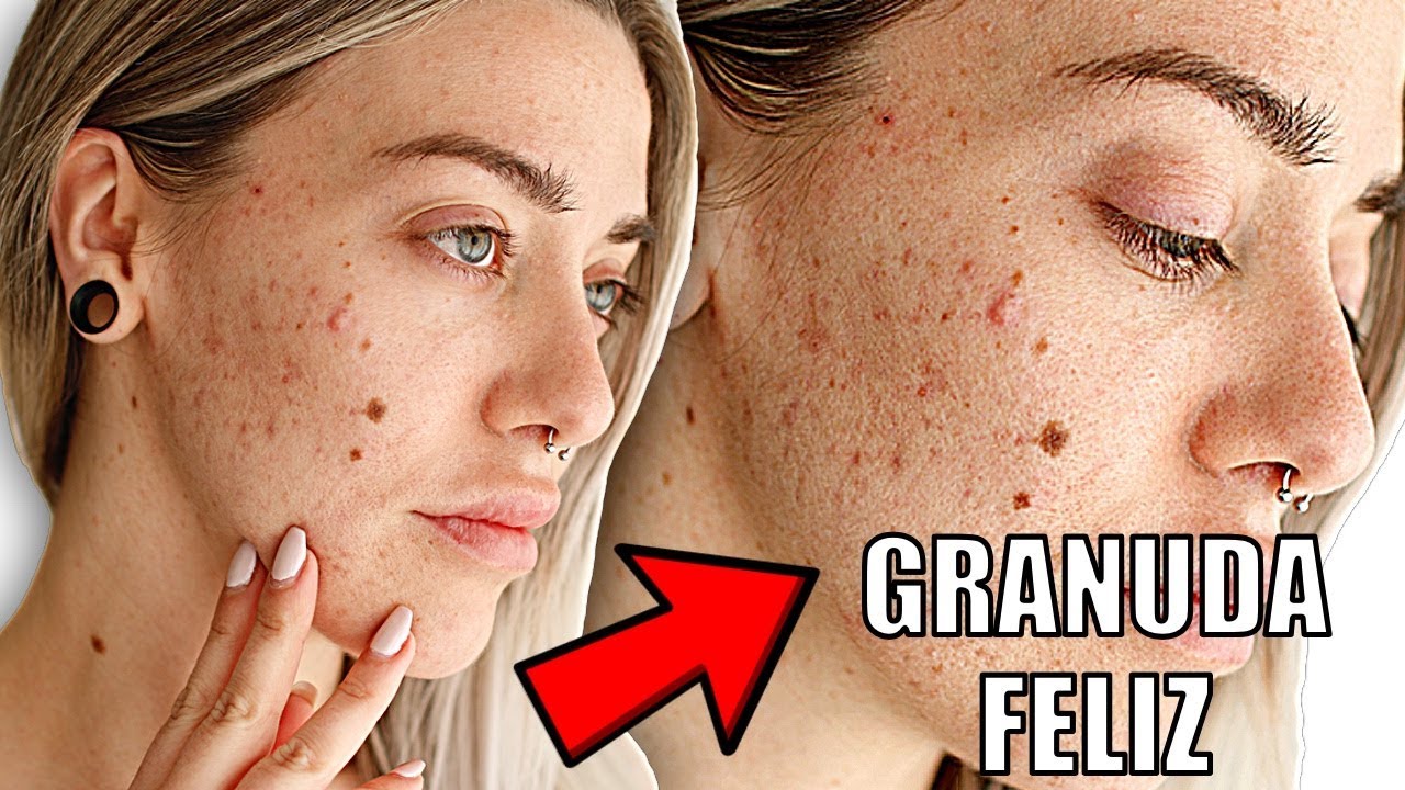 CÓMO CURAR EL ACNÉ CON LA MENTE | Consejos para recuperar la autoestima