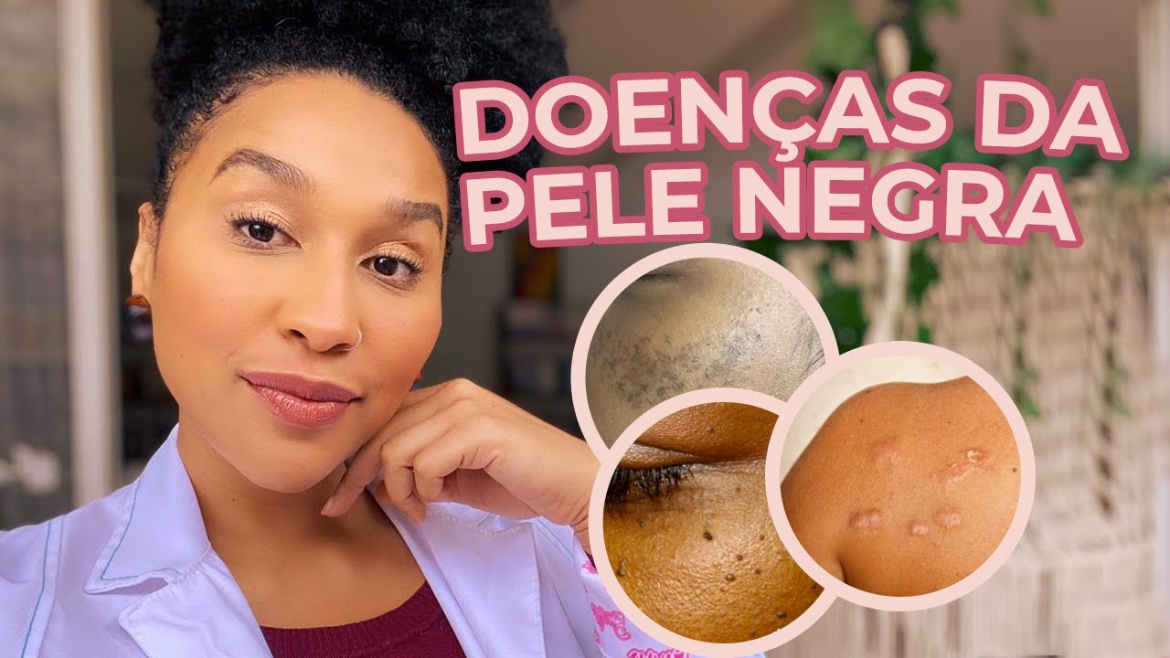 DOENÇAS DA PELE NEGRA: QUAIS SÃO? EXISTE TRATAMENTO?