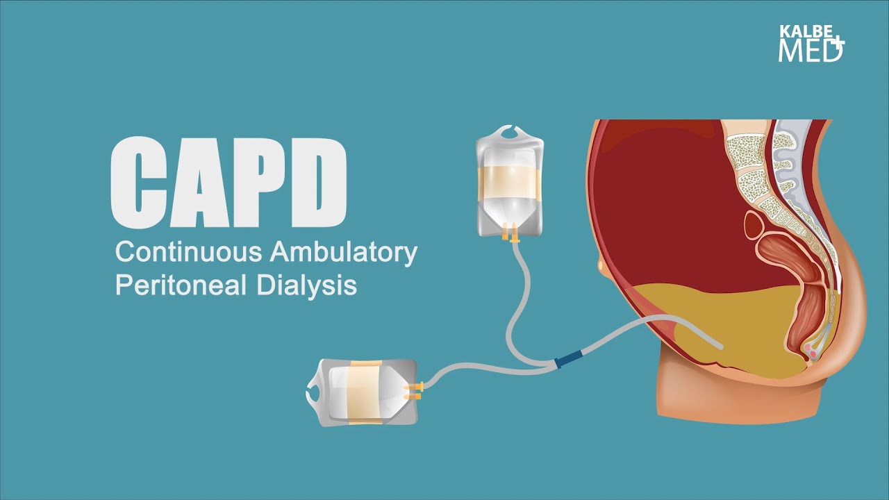 KalbeMed  - CAPD (Continuous Ambulatory Peritoneal Dialysis)