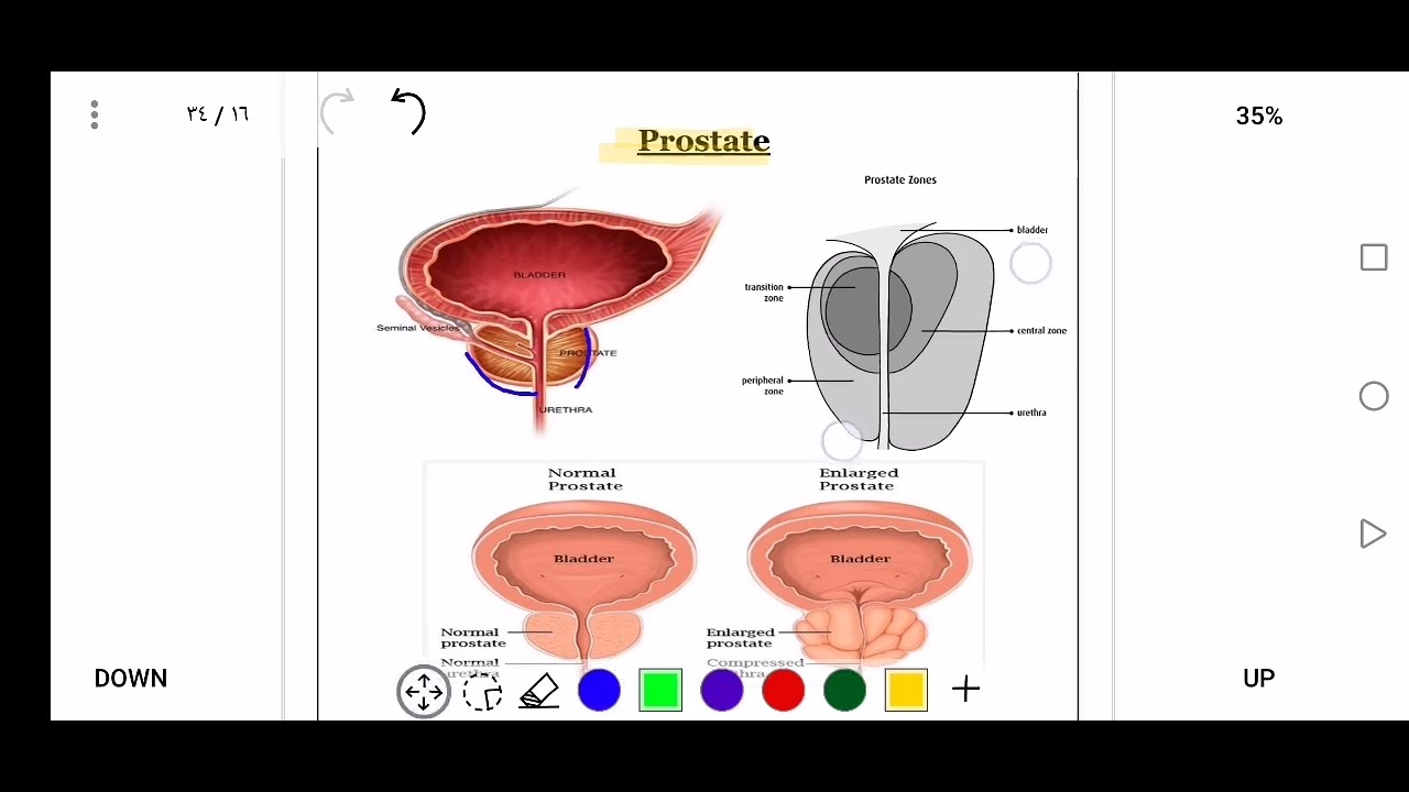 Benign prostatic hyperplasia (BBH)
