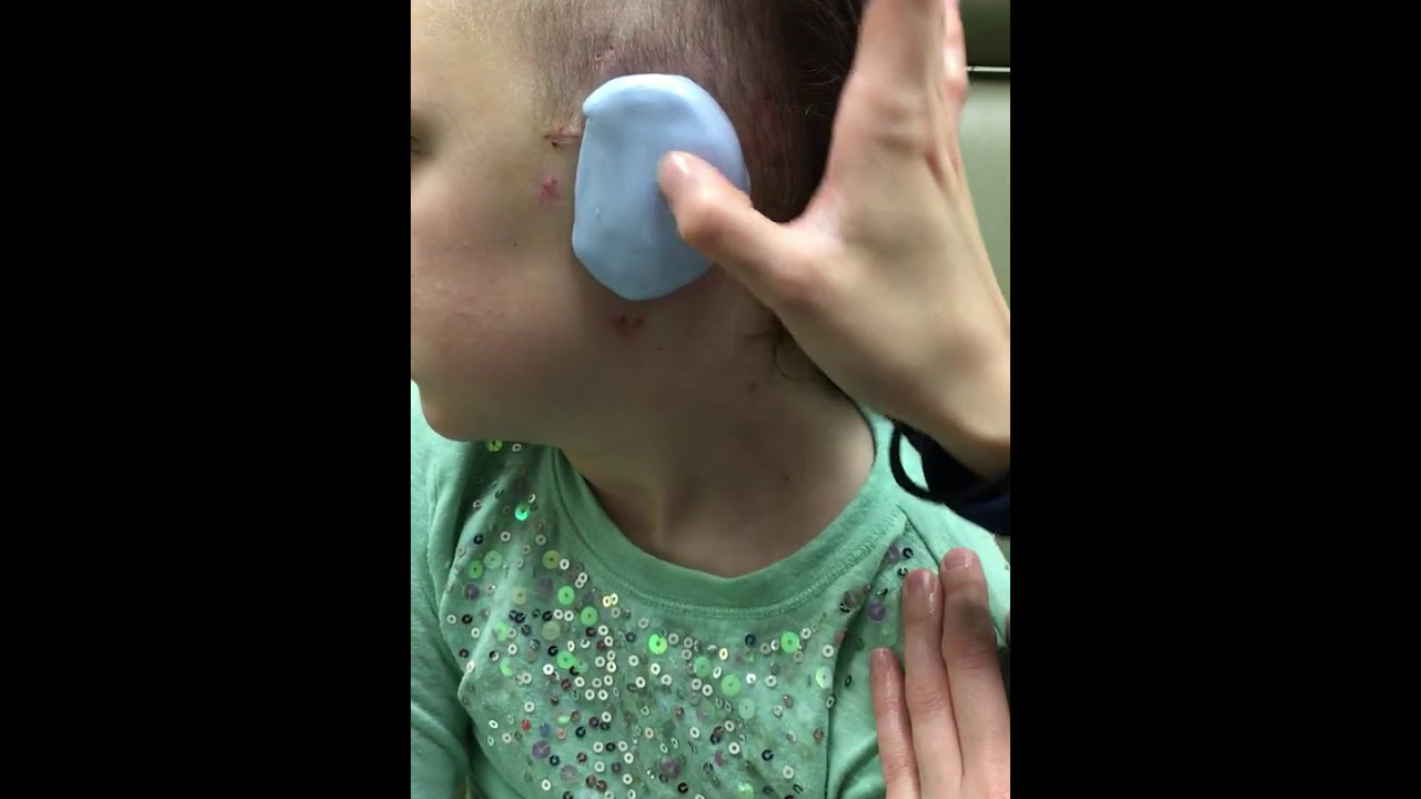 How to Make a Post-Operative Silicon Ear Mold