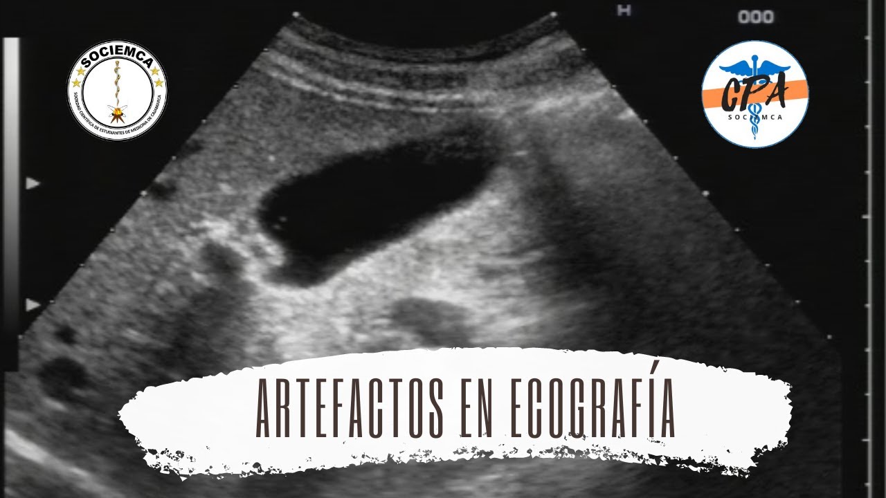 Artefactos en Ecografía
