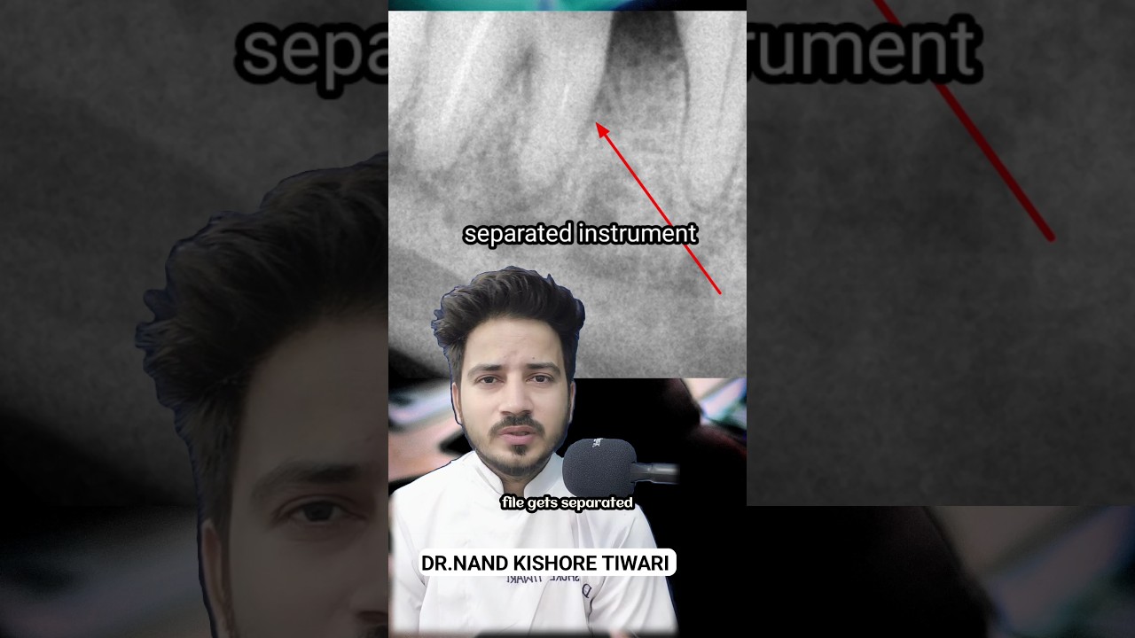 HOW i RETRIEVE Broken File From MANDIBULAR MOLAR  
