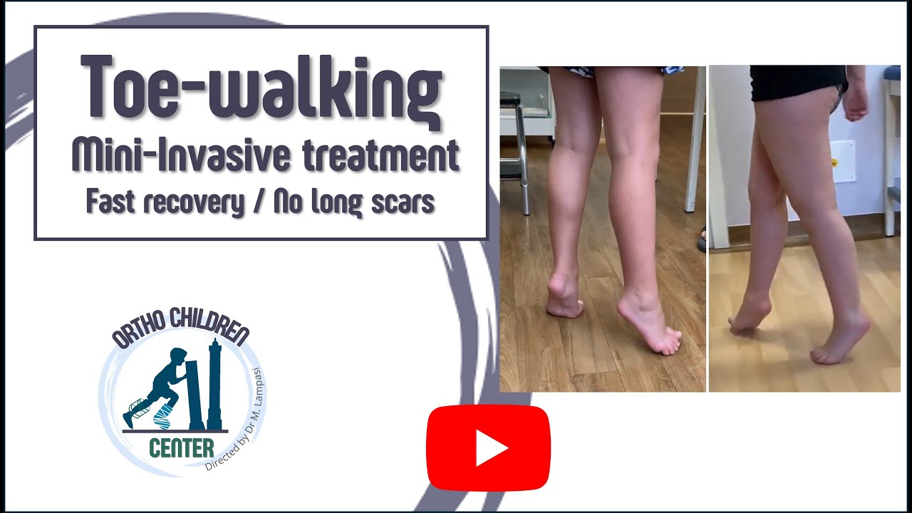 Toe walking in children: mininvasive operation, fast recovery, no long scars (OrthoChildren, Italy)