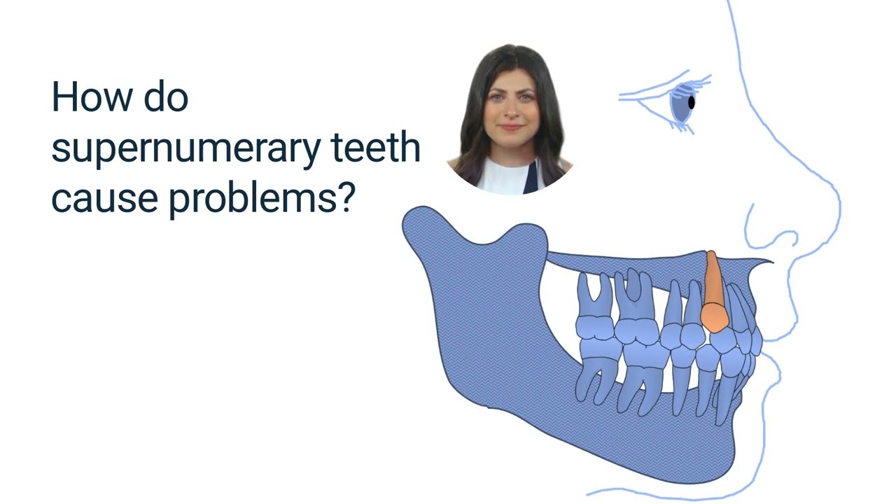 Supernumerary tooth