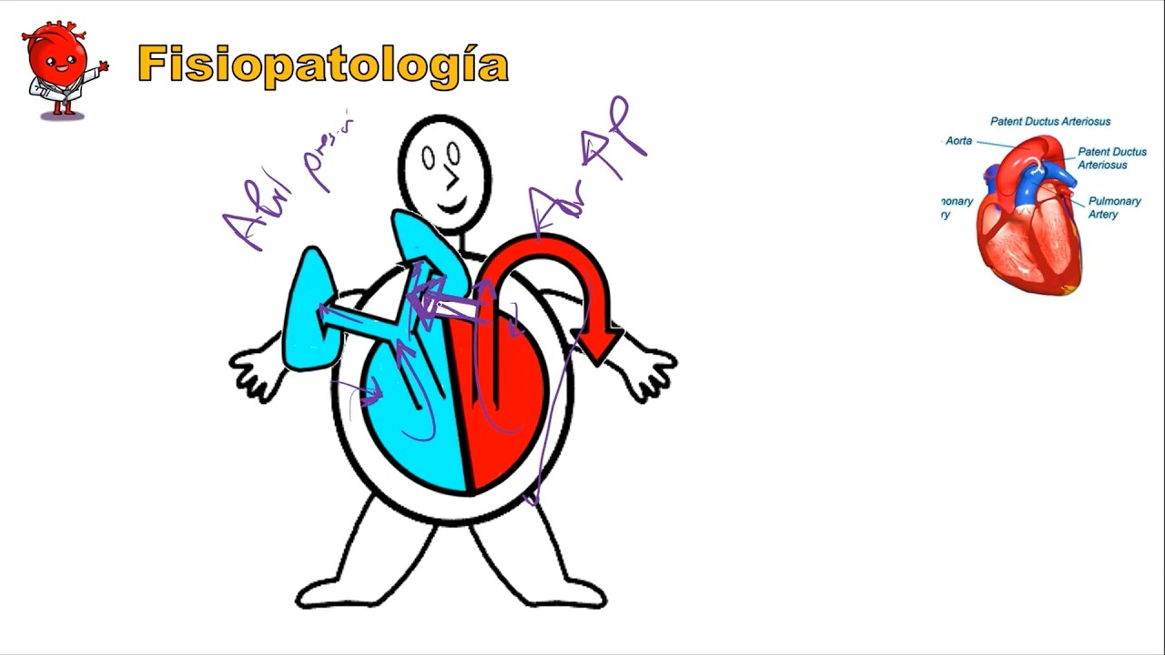 Conducto arterioso persistente | Epidemiolog&iacute;a y Fisiopatolog&iacute;a