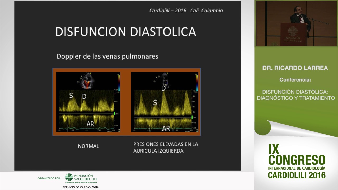 Disfunción Diastólogica, Dr Ricardo Larrea