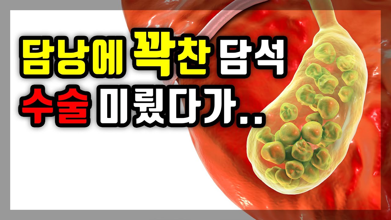 담석 수술 미뤘다가 결국! ｜담석으로 꽉찬 담낭 제거수술 이야기