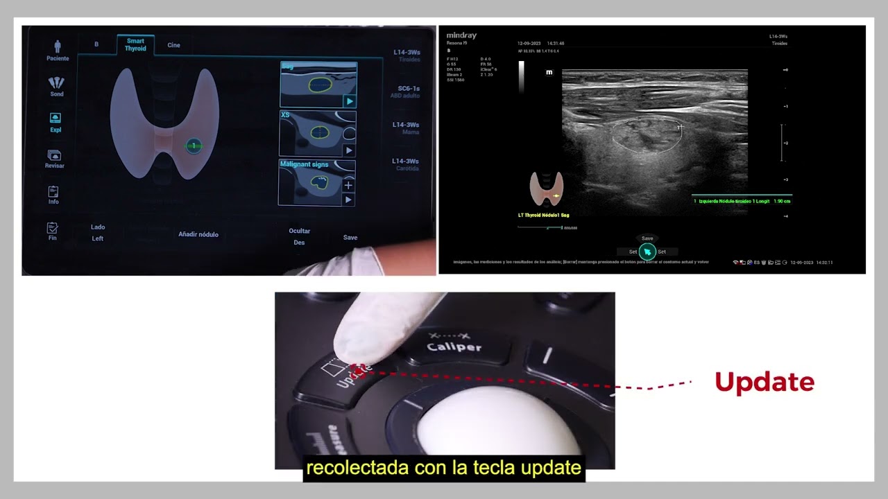 Smart thyroid Resona i9