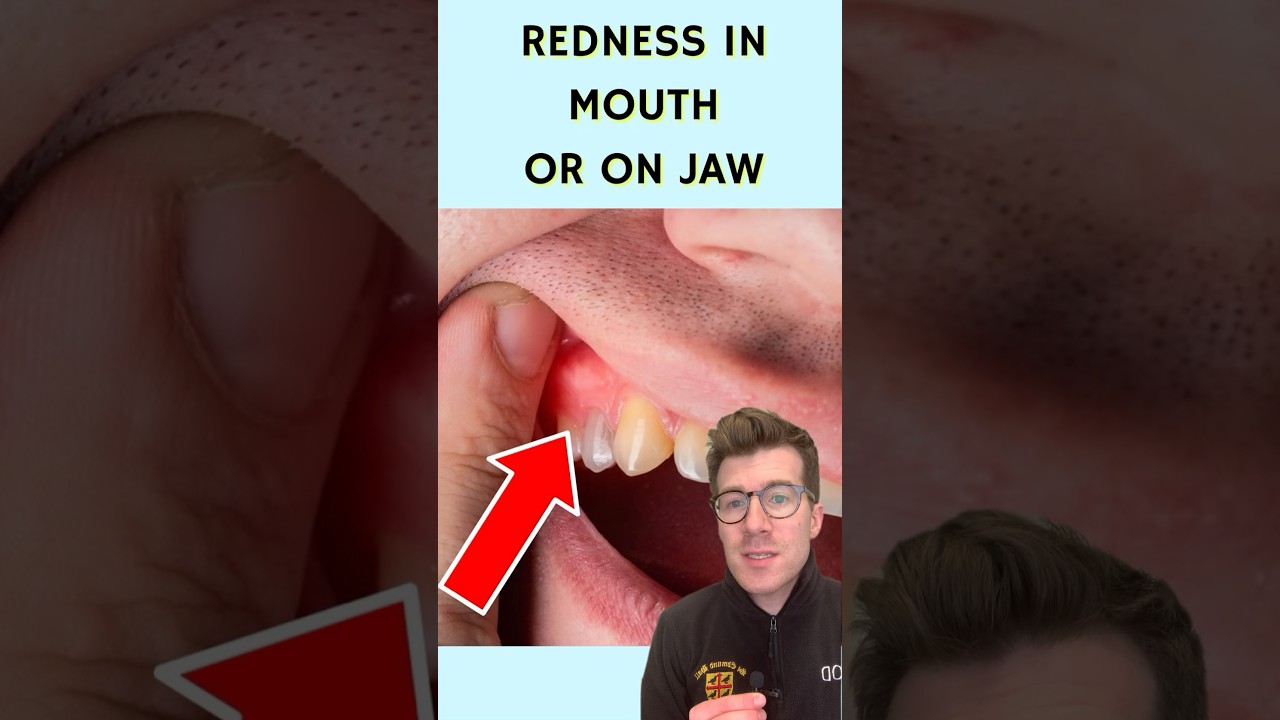 7 signs of a dental abscess &hellip; #shorts