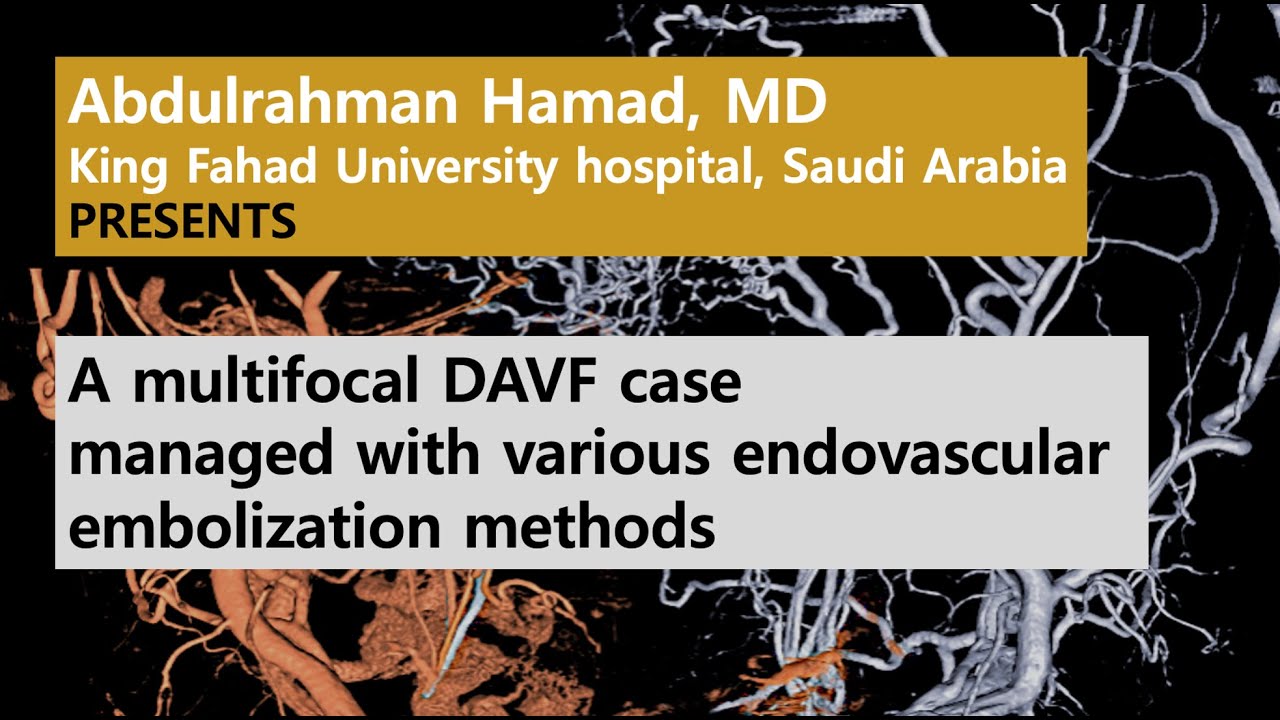 [NI Case] A multifocal DAVFs including posterior condylar vein embolized in diverse methods