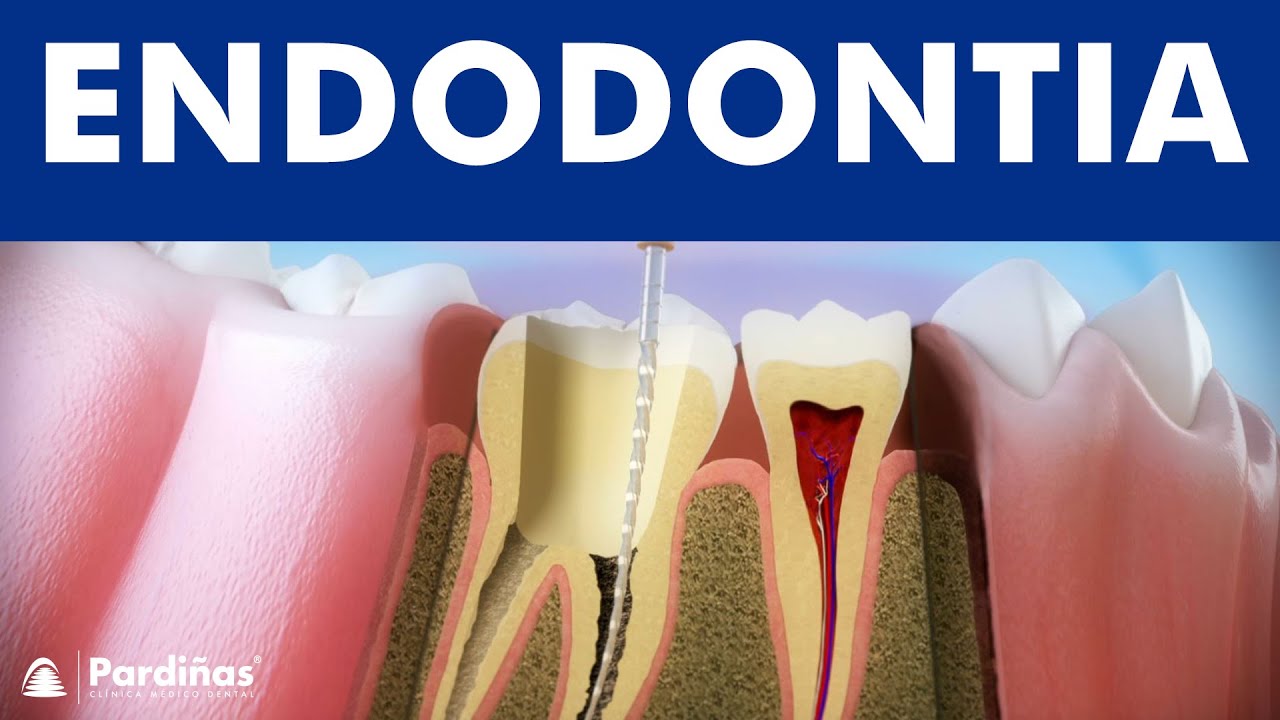 Endodontia – Tratamento endodôntico para cárie dentaria ©