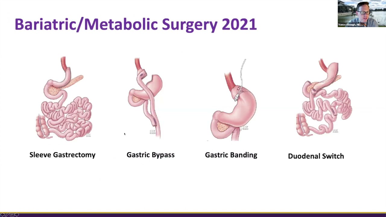 Weight Loss Surgery Seminar Hosted by Dr. Vance Albaugh