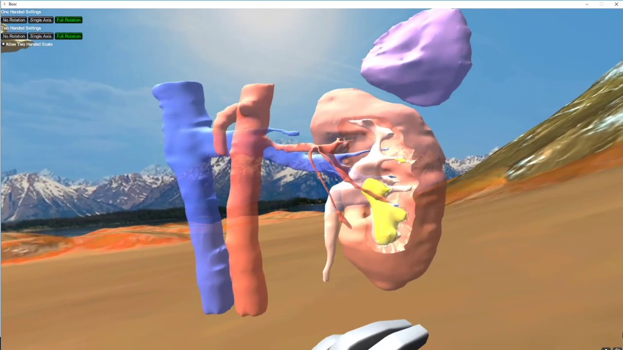 Virtual Reality - Kidney Stone Removal