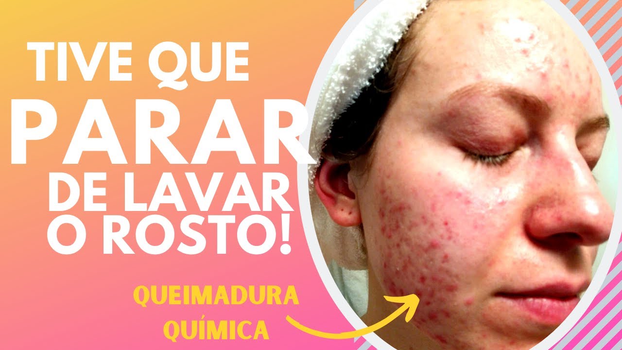 Pele DESIDRATADA: como salvei a barreira protetora da minha pele depois de uma QUEIMADURA QUÍMICA