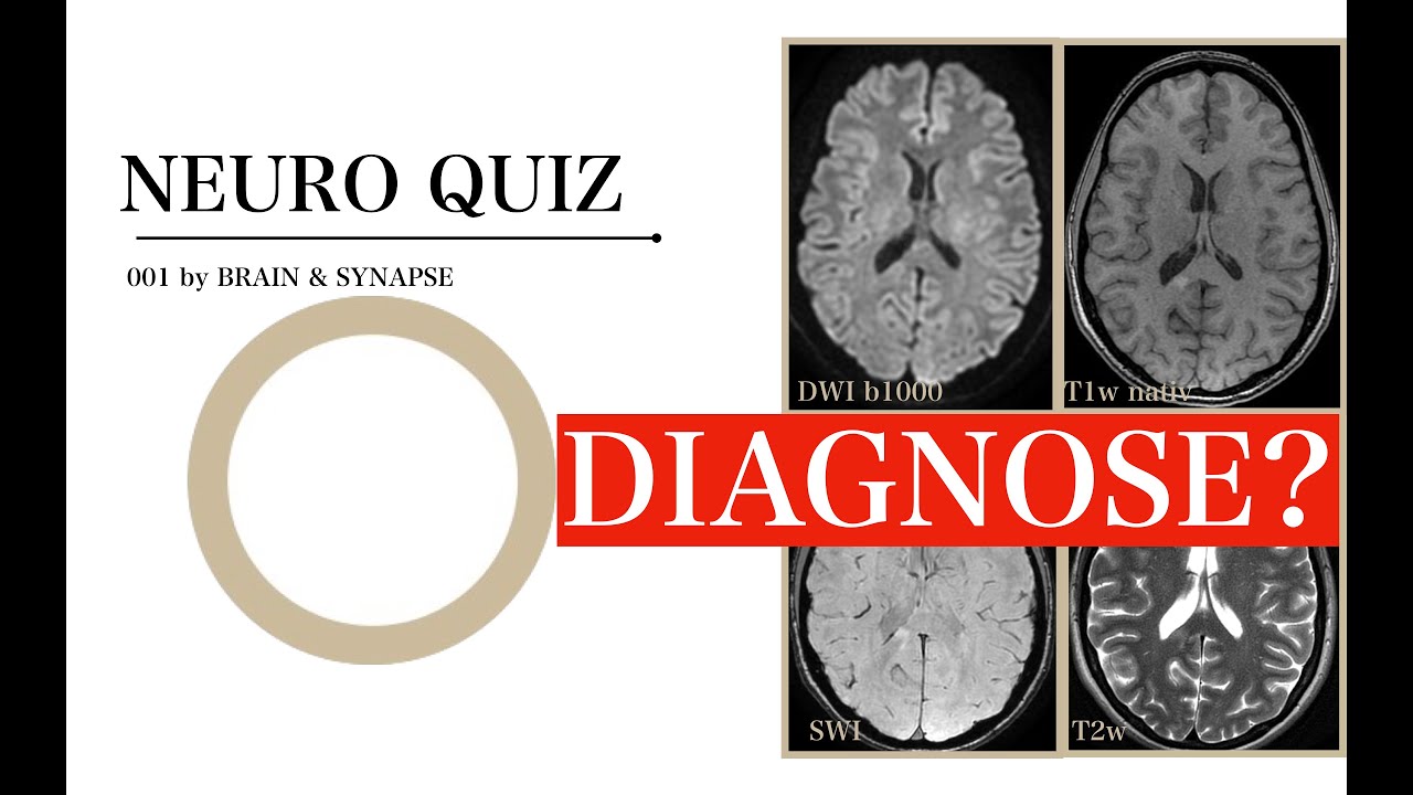 Neuro Quiz 001 I Diagnose? I Neuroradiologie I Gehirn I Brain & Synapse