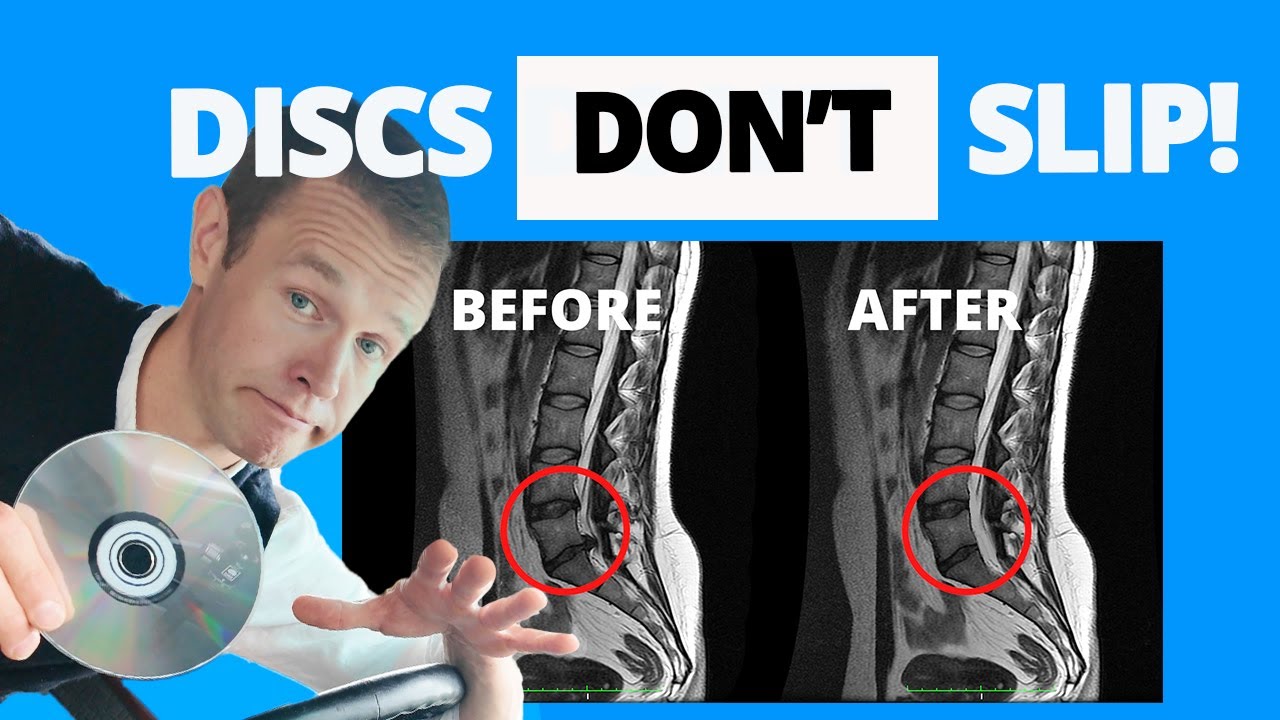 The Truth About Disc Protrusions: How They Really Heal