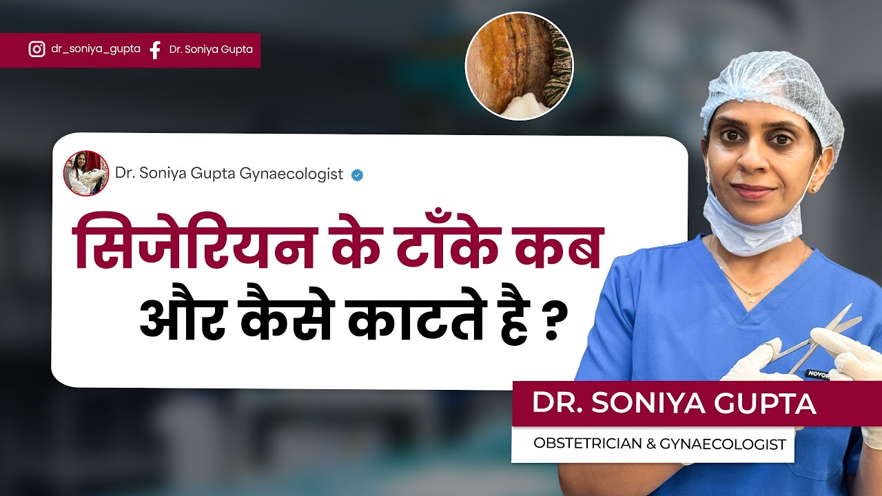 सिजेरियन के टांके कब और कैसे काटे जाते हैं? पूरा सच जानें | C-Section Stitches Removal Guide 