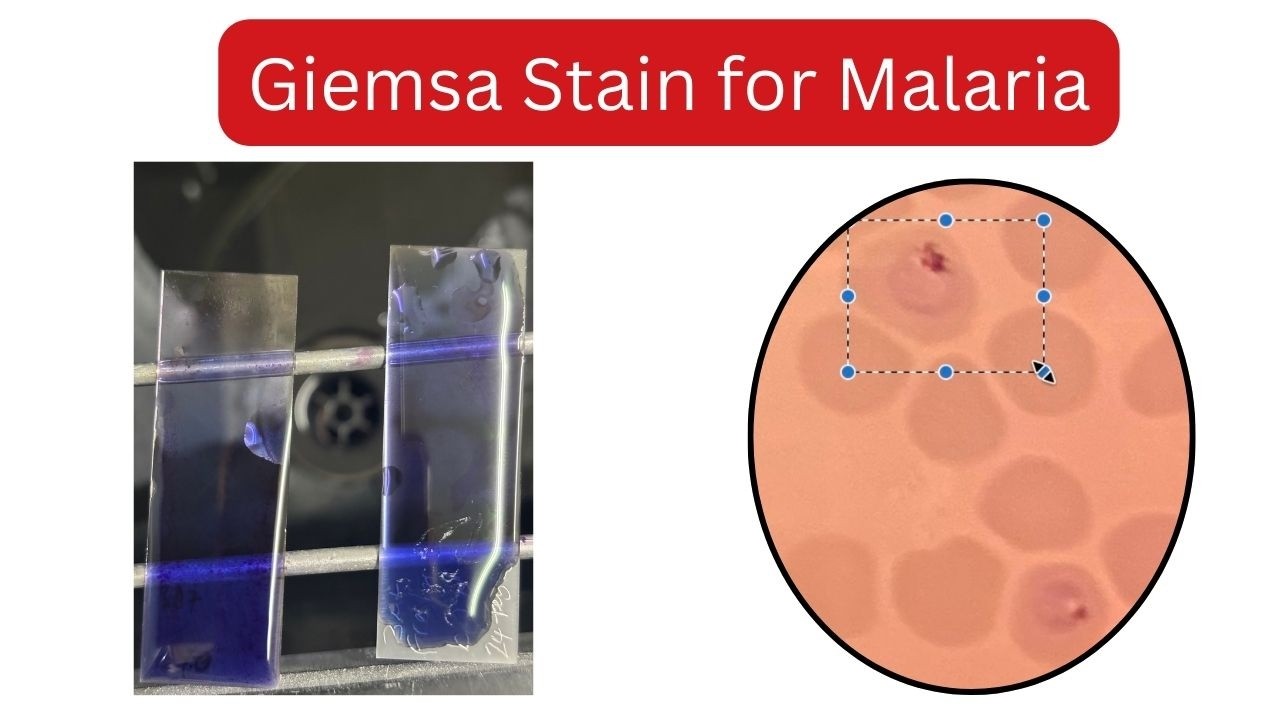 HOW TO IDENTIFY MALARIA UNDER MICROSCOPE | Giemsa stain