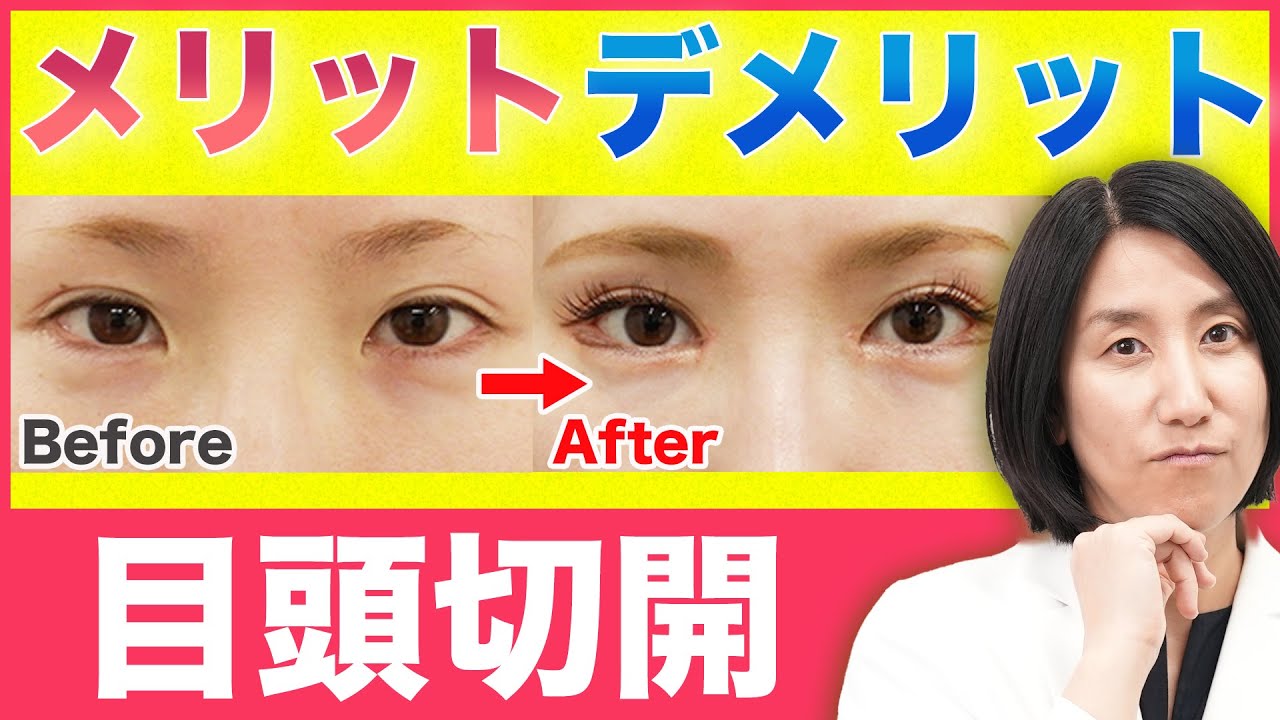 【目頭切開】自然に目元が華やかに｜目頭切開のメリットやデメリット