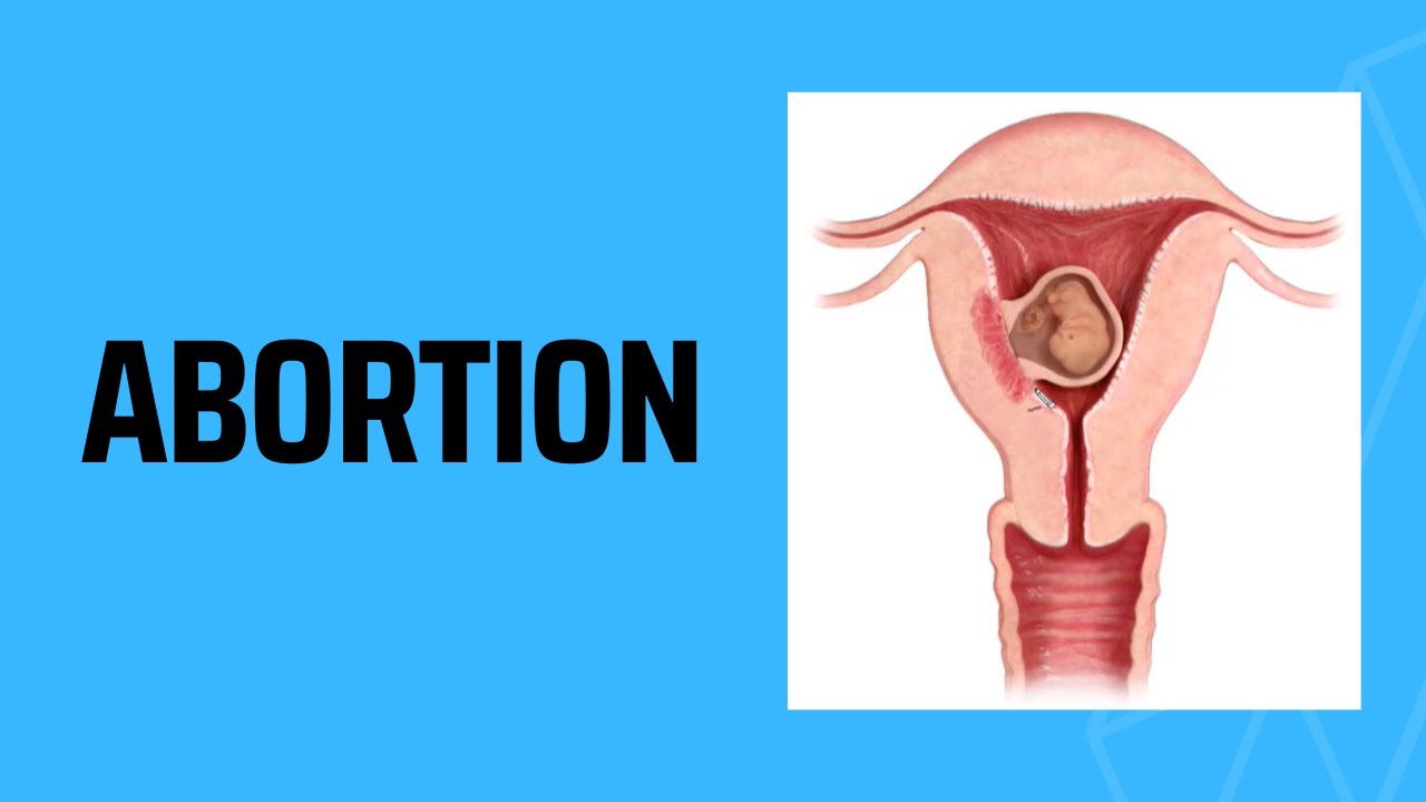 Abortion (Medical School Review)