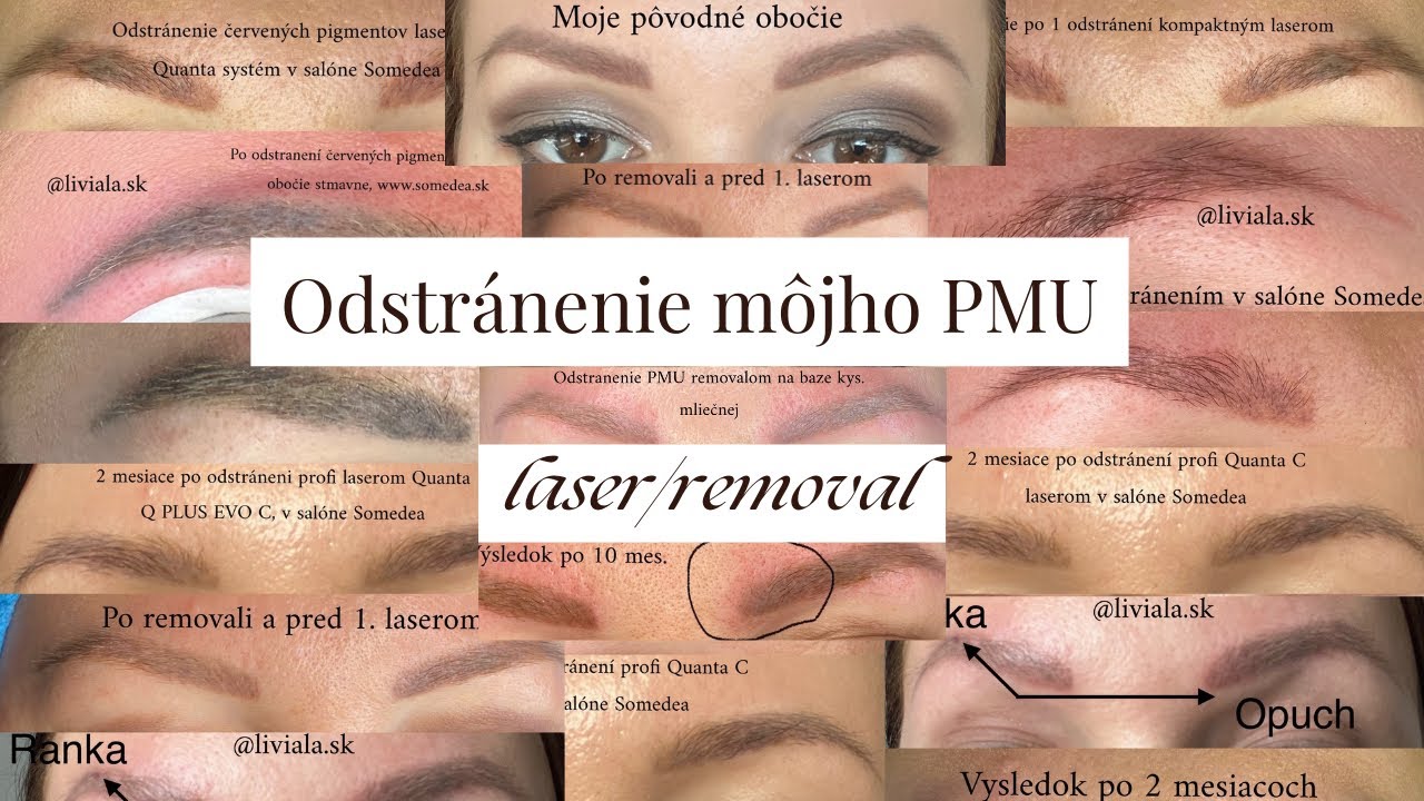 Odstránenie PMU obočia - laser/removal 🌹