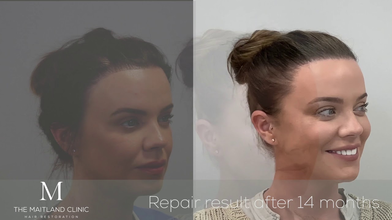 Maria Fowler Hair Transplant Final Result-1873 FUT 14 Months
