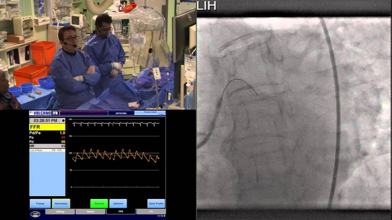 Drs Justin Davies and Iqbal Malik use IFR Scout to discriminate diffuse from focal coronary disease