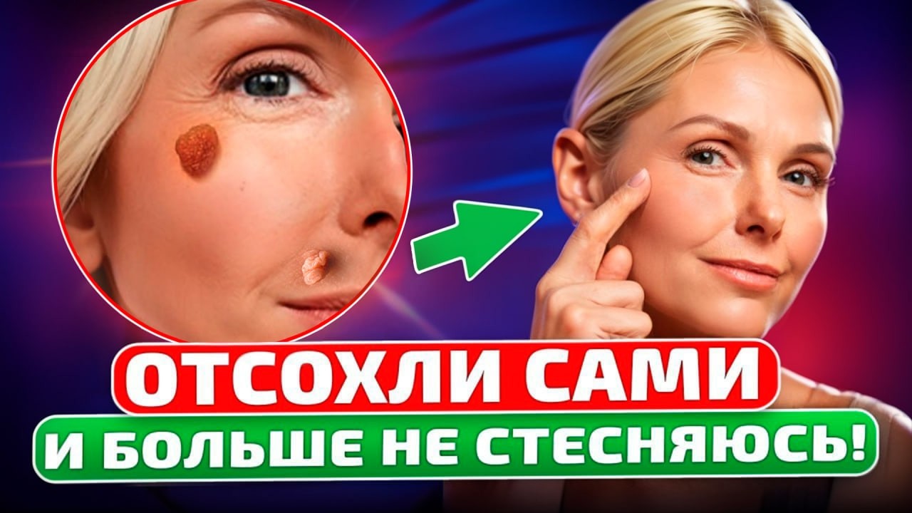 Жидкий «хирург без ножа»! Папилломы, бородавки и другие образования на коже боятся этого средства!