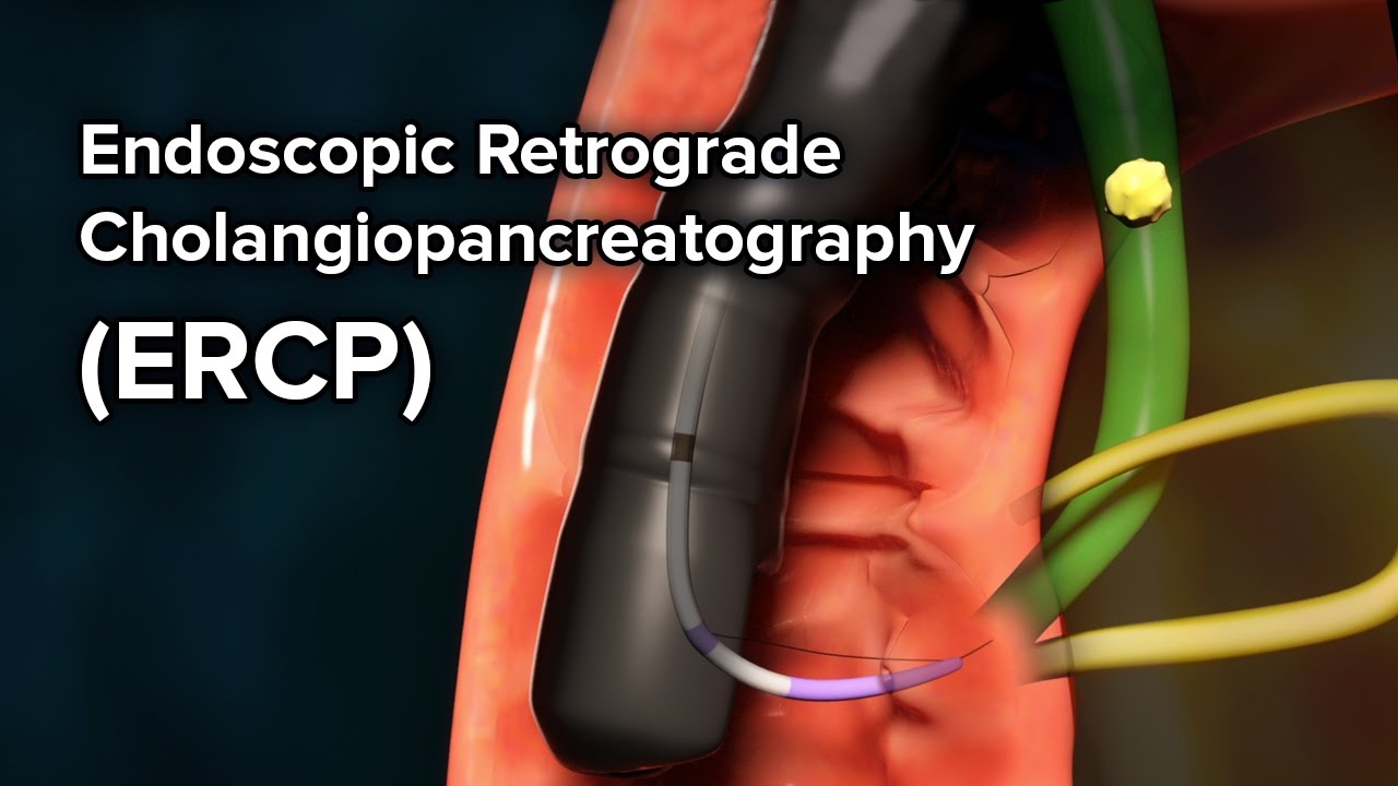 Pediatric ERCP | Cincinnati Children's