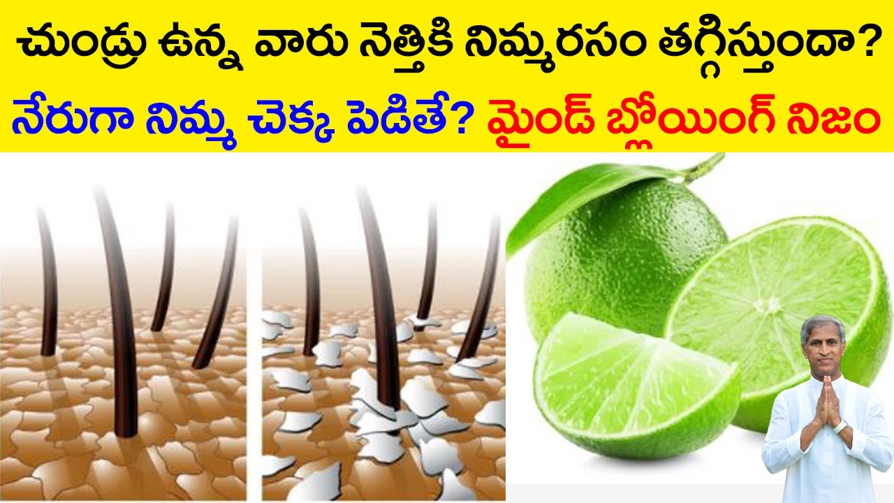 Hair Dandruff | చుండ్రు ఉన్న వారు నెత్తికి నిమ్మరసం పెడితే ? | Dr Manthena Satyanarayana Raju Videos