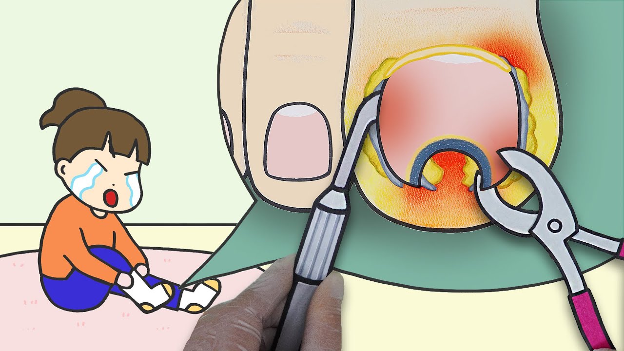 😵보기만해도 아픈 내성발톱 치료하기! :: 셀프어쿠스틱