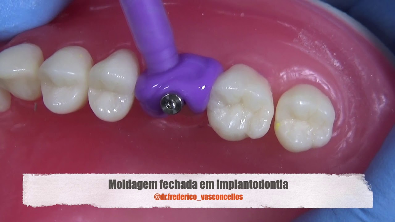 Moldagem em implantodontia: técnica fechada