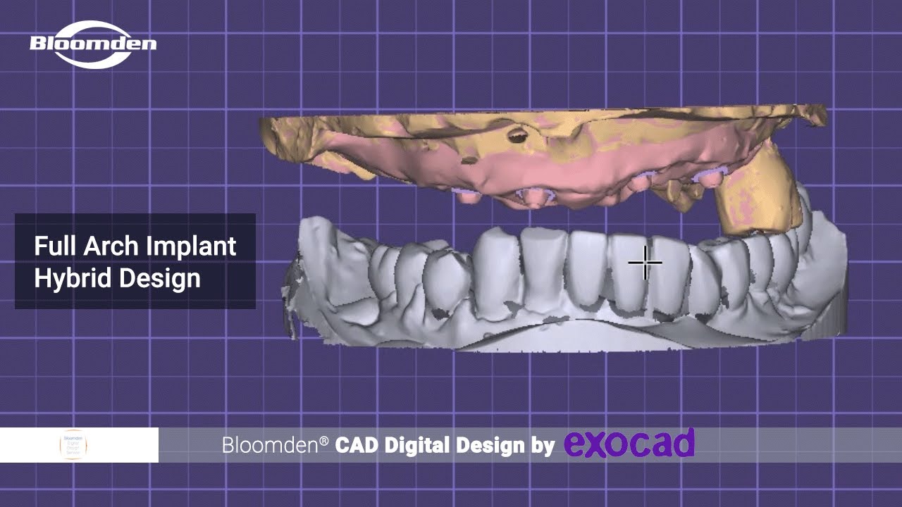 Full Arch Implant Hybrid Design by George