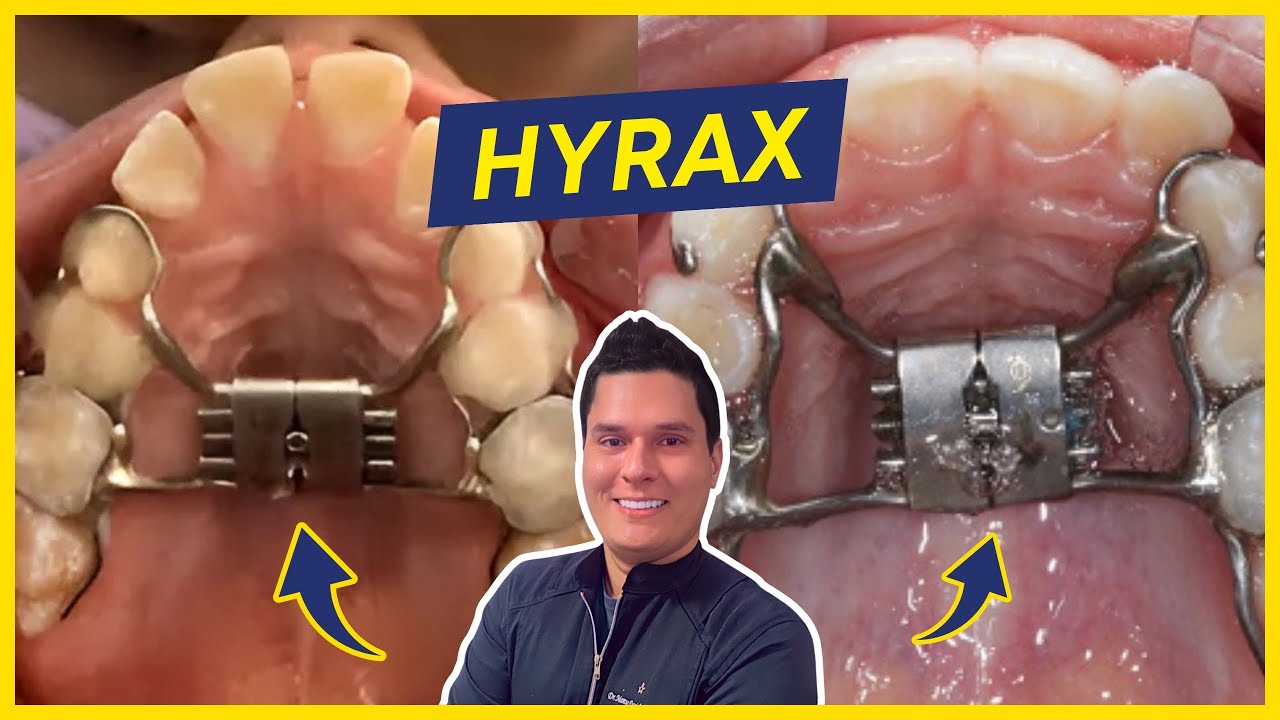 Aparelho Expansor Hyrax - Como funciona? (Protocolo de Uso)