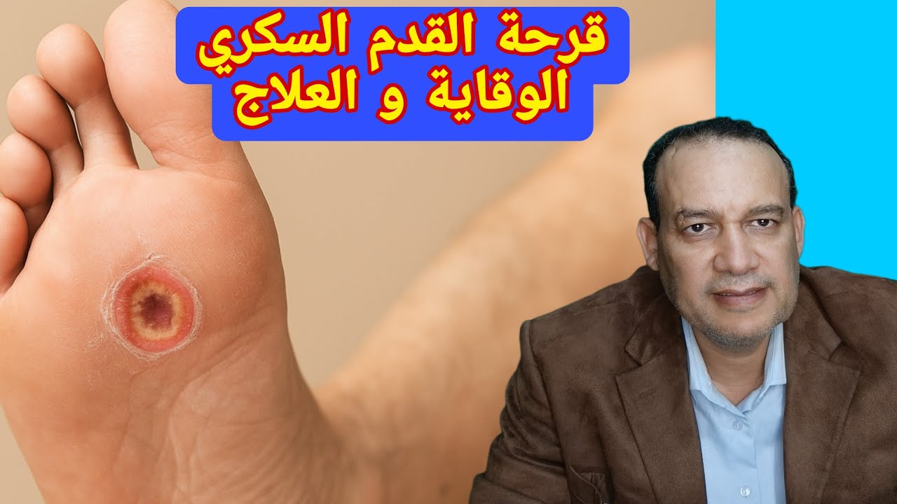 القرح السكرية: أخطر مضاعفات السكري وكيفية التعامل معها وفقا لأحدث التوصيات الطبية