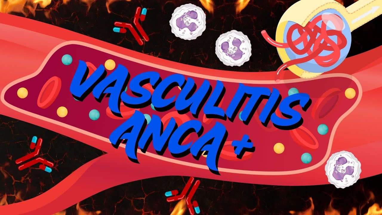 VASCULITIS ANCA