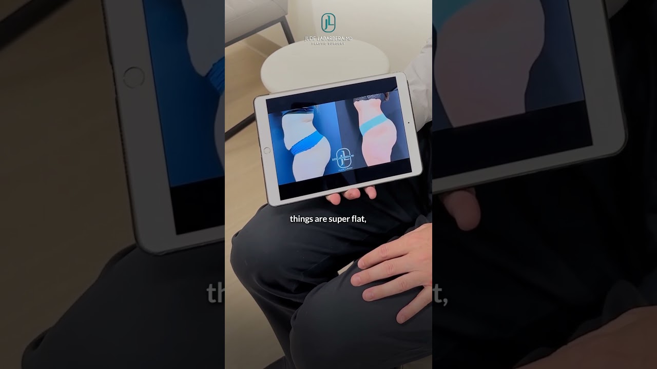 1 Year Post-Tummy Tuck and Liposuction of Flanks by Dr. LaBarbera