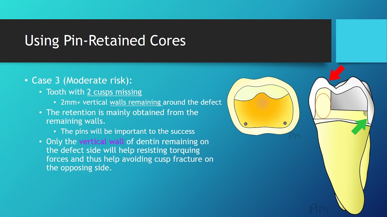 Using Pin-Retained Core for Holding Crowns