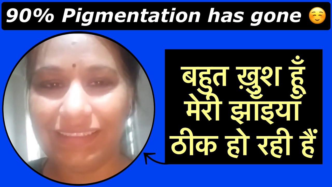 बहुत ख़ुश हूँ मेरी झाँइयाँ ठीक हो रही हैं I My 90% Pigmentation has gone, I’m very happy 😆