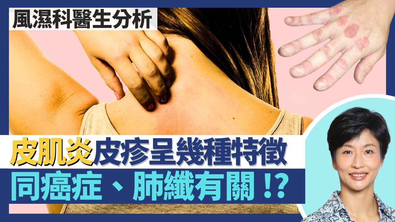 皮肌炎｜與癌症、間質性肺病肺纖維化有關？眼周圍／關節出疹、V形皮疹或是皮肌炎！自身免疫系統失調致皮膚肌肉發炎！｜王建芳醫生 風濕科醫生陳昭慧醫生 鍾浩然醫生｜人類健康研究所