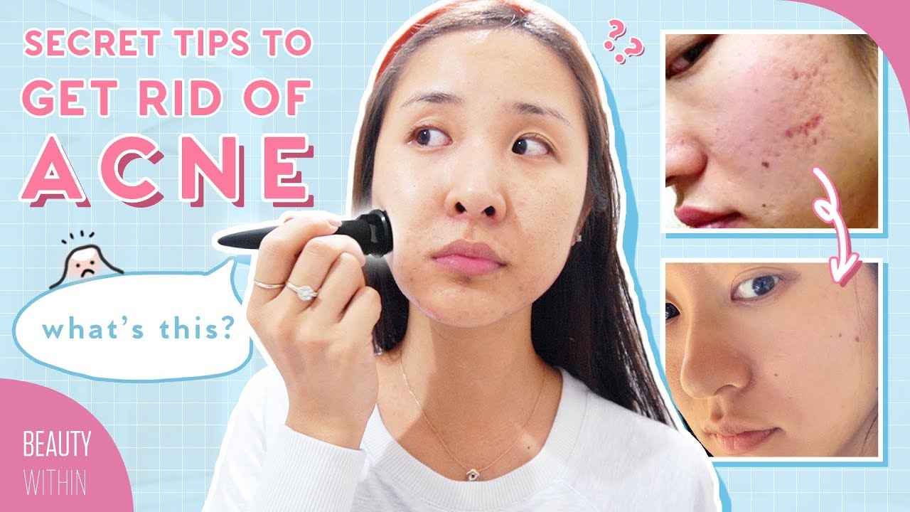 Banish CEO's Acne Story on How to Clear Hormonal Acne, Scarring & Hyperpigmentation (ft. Daisy Jing)