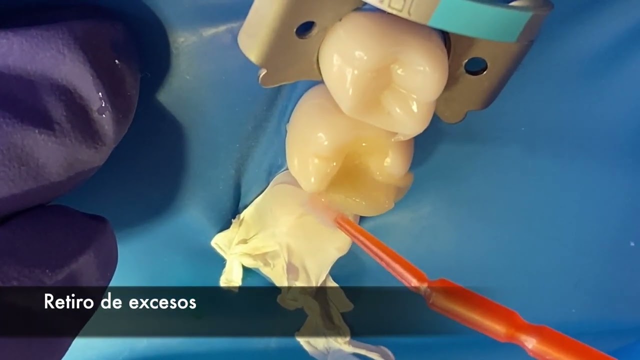 07 Cementación Incrustación Estética en Molar